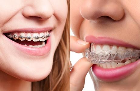 Braces vs. Invisalign—Which One is Right for You?