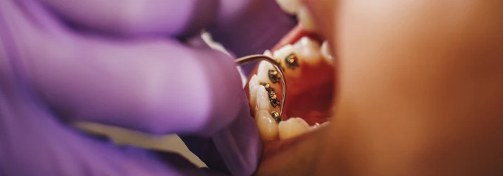 Orthodontist Orlando FL Benefits of Orthodontic Treatment extreme close up of an orthodontist with purple gloves working on someone's braces that are attached to the back of the teeth