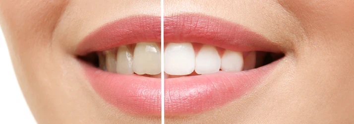 Orthodontist Orlando FL Teeth Whitening close up of a woman's smiling mouth showing before and after teeth whitening